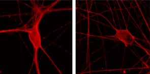 These patient-derived motor neurons have been immunostained to show Hsc70/HSPA8 in the cells. The image on the right shows a neuron with normal TDP-43, and the image on the left shows a neuron producing mutant TDP-43, which causes a reduction in the Hsc70/HSPA8 present in the cell. (Image: Rita Sattler/Barrow Neurological Institute) These patient-derived motor neurons have been immunostained to show Hsc70/HSPA8 in the cells. The image on the right shows a neuron with normal TDP-43, and the image on the left shows a neuron producing mutant TDP-43, which causes a reduction in the Hsc70/HSPA8 present in the cell. (Image: Rita Sattler/Barrow Neurological Institute)